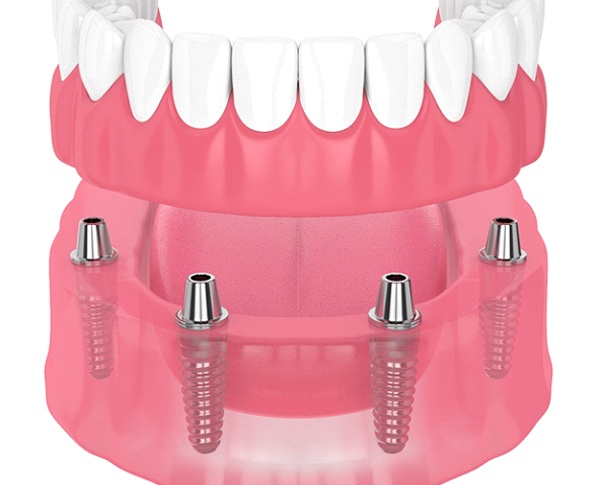 3D illustration of an implant denture