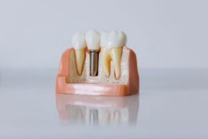 The Comparison Guide: Implants vs. Bridges vs. Dentures